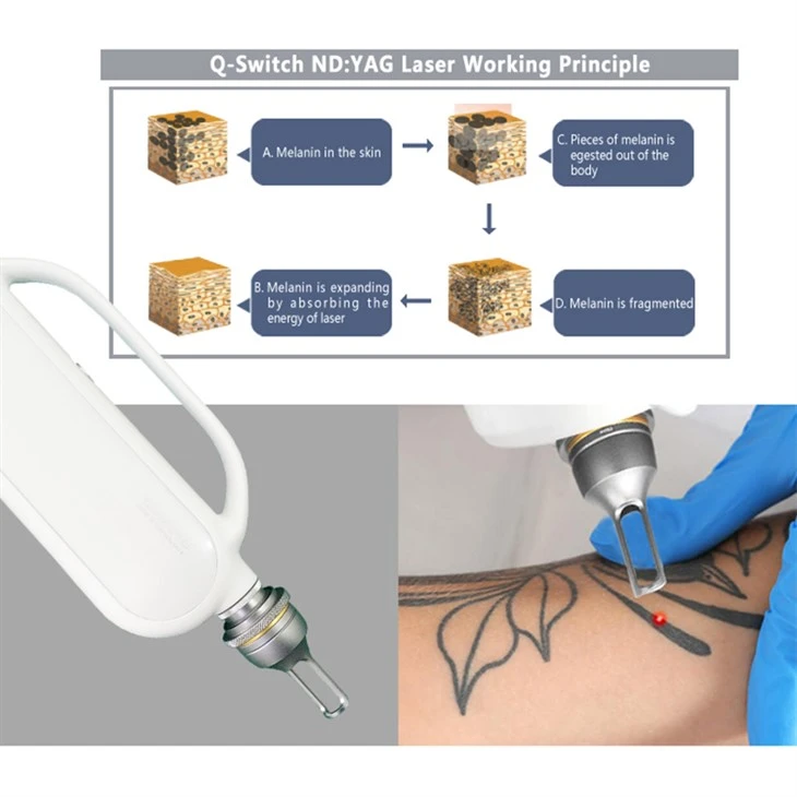 Q-Switch ND YAG Laser Tattoo Removal Machine